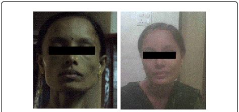 Patient Before And After Completion Of Treatment For Tuberculosis