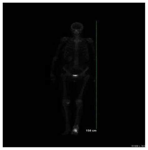 Technetium 99m Mdp Whole Body Bone Scan Displaying Intense Increased