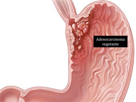 Tumore Allo Stomaco Chirurgia Endoscopica Unina