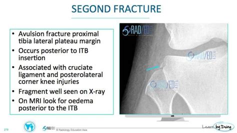 MRI SEGOND FRACTURE WHAT TO LOOK FOR Radedasia