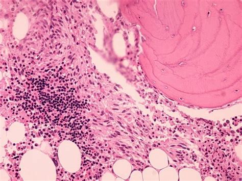 Mastocitosis Sistémica