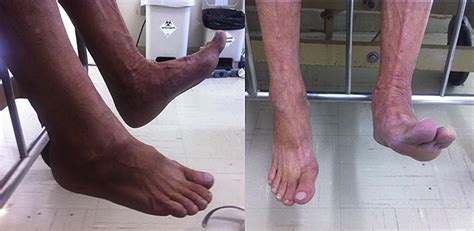 Acute Foot Drop Syndrome Mimicking Peroneal Nerve Injury An Atypical