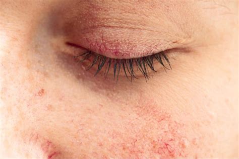 Skin Treatment For Rosacea Skin To Love Clinic