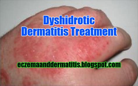 Dyshidrotic Dermatitis Treatment Eczema And Dermatitis