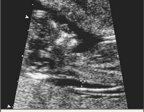 Midsagittal Ultrasound Study Of The 13 Week Fetus Of Another Patient