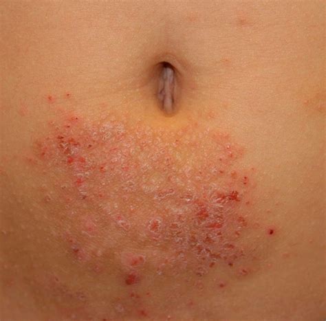 Rash On Stomach Causes Pictures And Back Breast Groin Belly Button