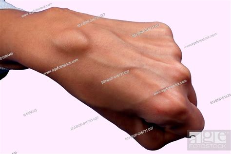 Synovial Cyst Of The Wrist In A Year Old Woman Stock Photo Picture And Rights Managed Image