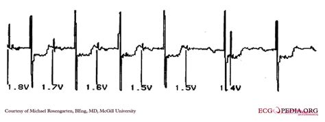 Mcgill Case 146 Ecgpedia