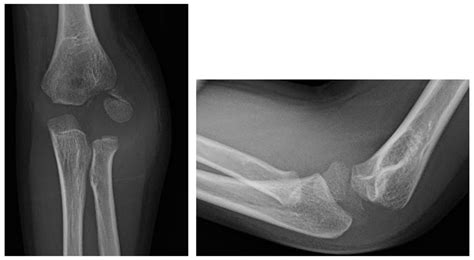 Splinter Series Fracture After A Fall From A Bunk Bed Laptrinhx News