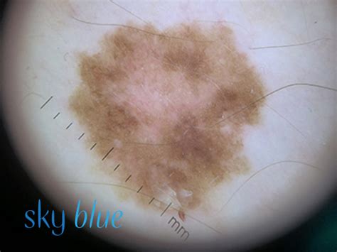 Skin Cancer What You Need To Know And A Bit More Sky Blue Dermatology