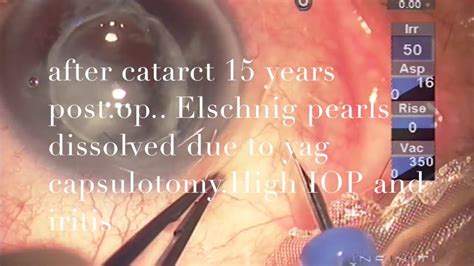Peculiar Case Of After Cataract Managed By Pars Plana Route By Dr