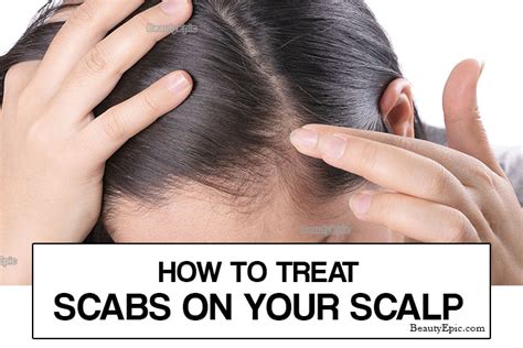 How To Get Rid Of Scabs On Scalp What It Is Causes And How To Treat