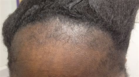 Derm Dx Hair Loss In A Teen Girl Clinical Advisor