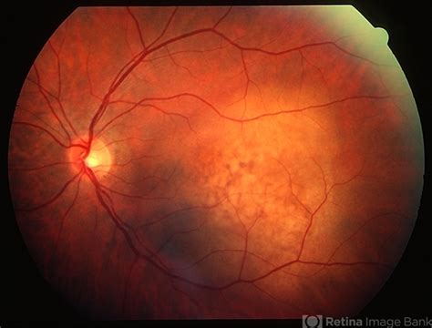 Choroidal Metastasis Case 1 Retina Image Bank