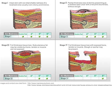 Pressure Ulcer Stage 5