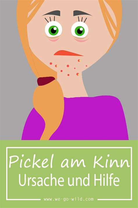 Diese pickelmale sind das resultat von falscher pickelbekämpfung. Pickel am Kinn loswerden - Das hilft wirklich gegen Pustel ...