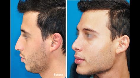 How To Get A Chiseled Face For Men Youtube