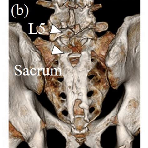 Spina Bifida Occulta Sbo A Sbo Lumbar Sbo Was Found At L5 There