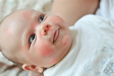 Repeated exposure to a food allergen can cause the allergic reaction to become more severe. Can a 3 Month Old Have Allergies? | New Health Advisor