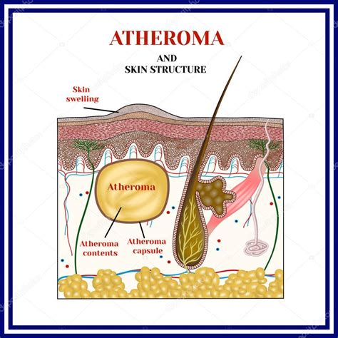 Atheroma Cyst