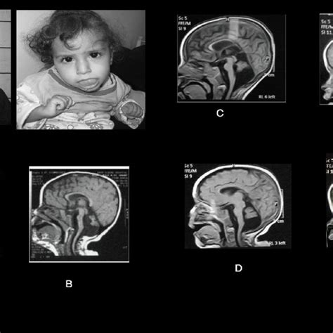Joubert Syndrome And Related Cerebellar Disorders Note Specific
