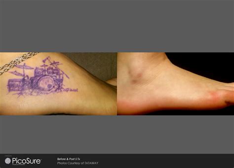 When planning on getting laser removal, you should be mindful. Laser Ink - PicoSure Laser Tattoo Removal Specialists ...