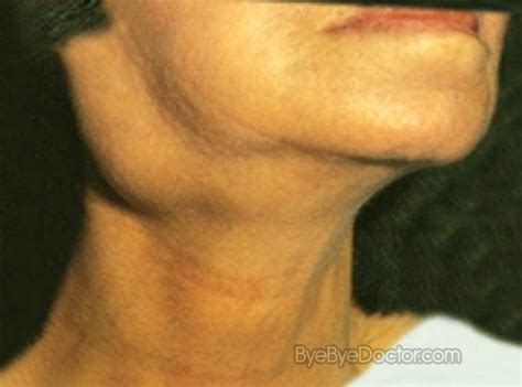 Swollen Glands In Neck Causes And Treatment Minhhai2d Help Doctor