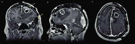 A Coronal Cranial Mri With Contrast Showing A Heterogeneous Enhancing