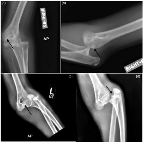 Figure 1 From Bilateral Medial Epicondyle Fractures With Elbow