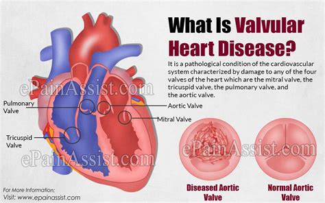 What Is Valvular Heart Disease Valvular Heart Disease Tricuspid Valve