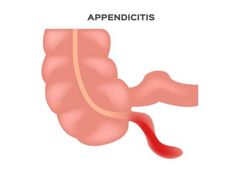 The Appendix And What It Does — Schopp Nutrition And Chiropractic Clinic