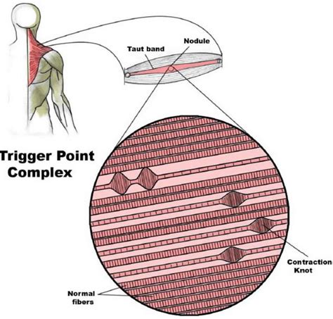 Myofascial Trigger Points Definition Signs Symptoms Diagnosis Therapy