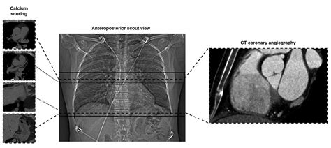 Scan Length Adjustment Of Ct Coronary Angiography Using The Calcium
