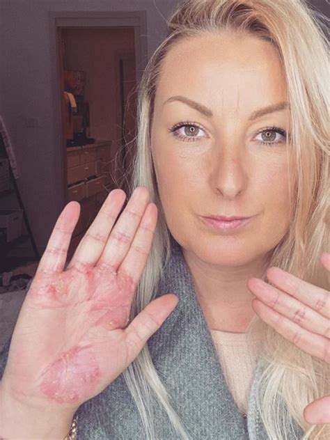 Mother Of Six Speaks Out On Living With An Extreme Skin Condition Au — Australias