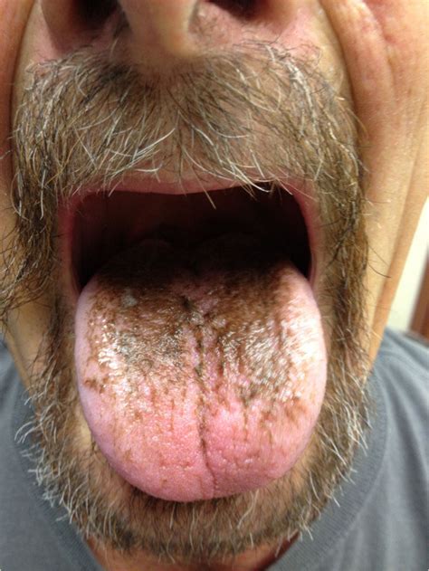 Brownish Black Discoloration Of The Posterior Two Thirds Of The Tongue