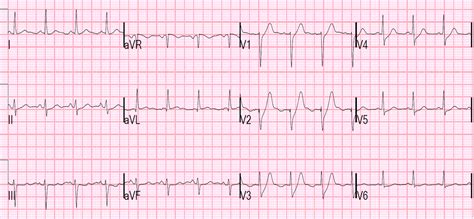 Descriptionde winter's t wave (ecg).svg. Dr. Smith's ECG Blog: Is the LAD really completely ...