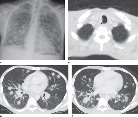 Primary Lung Tumors Other Than Bronchogenic Carcinoma Benign And