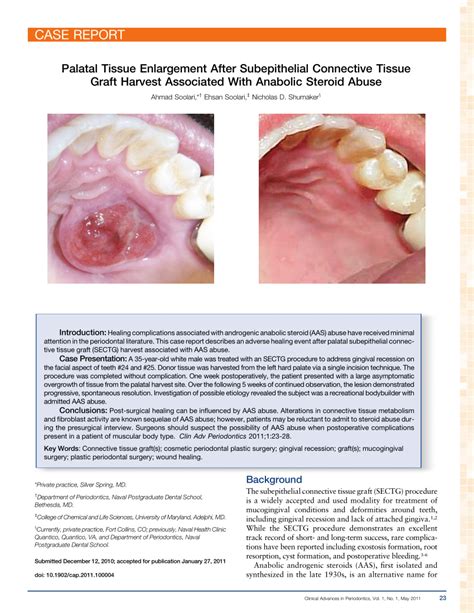 Pdf Palatal Tissue Enlargement After Subepithelial Connective Tissue