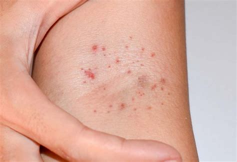 Petechiae On A Childs Arm