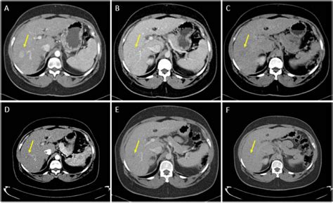 Spontaneous Regression Of Hepatocellular Carcinoma After