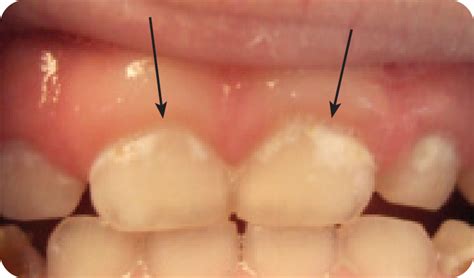How To Remove Baby Teeth Stain Kacey Millard