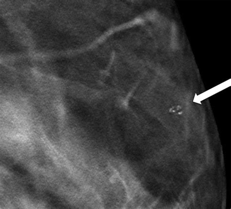 Calcifications At Digital Breast Tomosynthesis Imaging Features And Biopsy Techniques