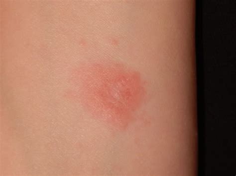 Red Bumps On Legs Dorothee Padraig South West Skin Health Care