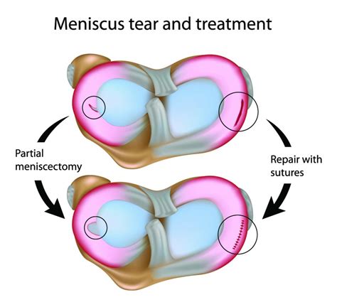 Answers To Your Questions About Surgery To Trim Out A Meniscus Tear