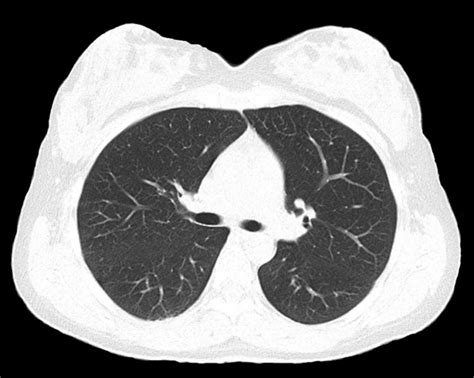Lung Cancer Screening By Ct Scan Risk Based Vs Uspstf Criteria