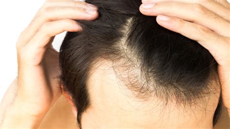 Understanding Hair Loss For Men The Guardian Mobile
