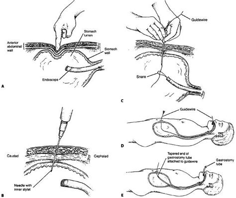 A The Procedure For Percutaneous Endoscopic Gastrostomy Includes