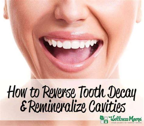Simply swish a tablespoon of coconut oil in your mouth for 20 minutes until your saliva and the oil turn a milky white color. How to Reverse Tooth Decay & Cavities | Wellness Mama