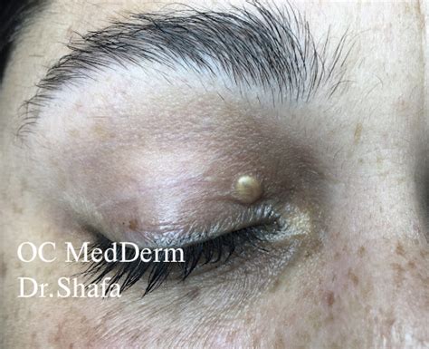 Eyelid Bumps Surgeries Cosmetic Dermatology Irvine And Orange County