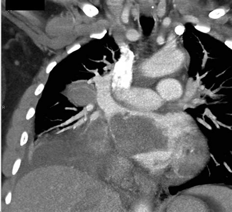 Lung Cancer With Direct Extension Into The Left Atrium Via The